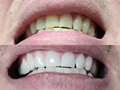 Caeloria LED Teeth Whitening Mouthpiece - Image 4